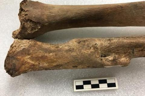 On the top is a normal tibia, on the bottom a tibia from the same individual which has healed following a fracture